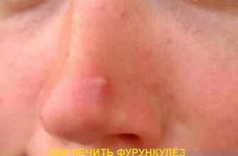 Лечение фурункулёза — что угрожает коже 6 alt="Лечение фурункулёза"