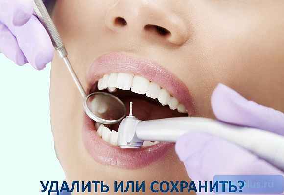 В каких случаях нужно удалять больной зуб alt="Удалять или лечить зуб"