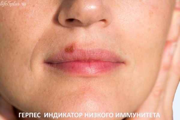 Вся правда о герпесе alt="Что такое герпес"
